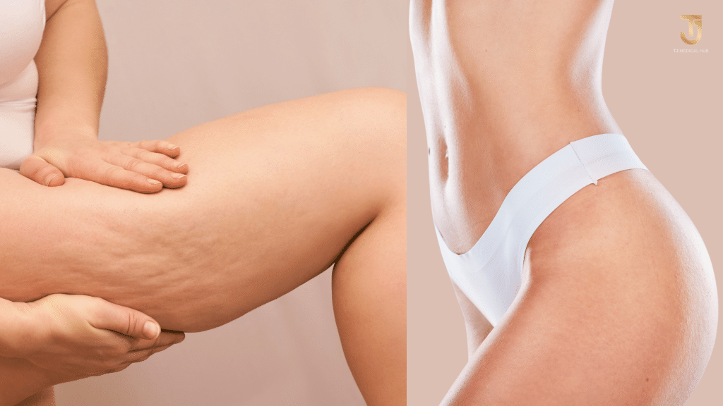 Liposuction in thailand