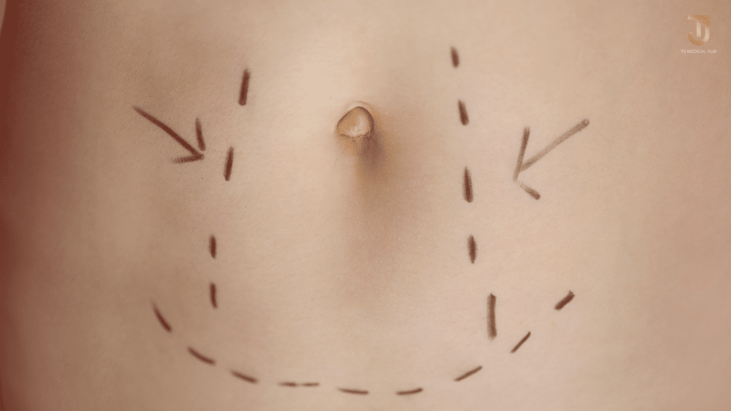 Liposuction in thailand