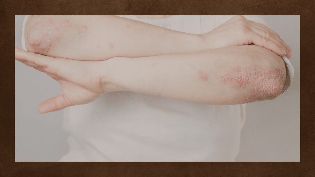 psoriatic arthritis