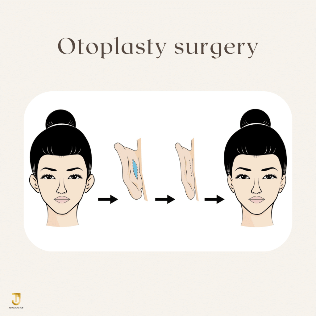Otoplasty surgery