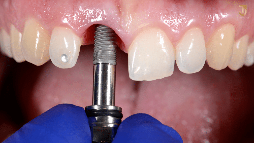 Dental implants  in Thailand