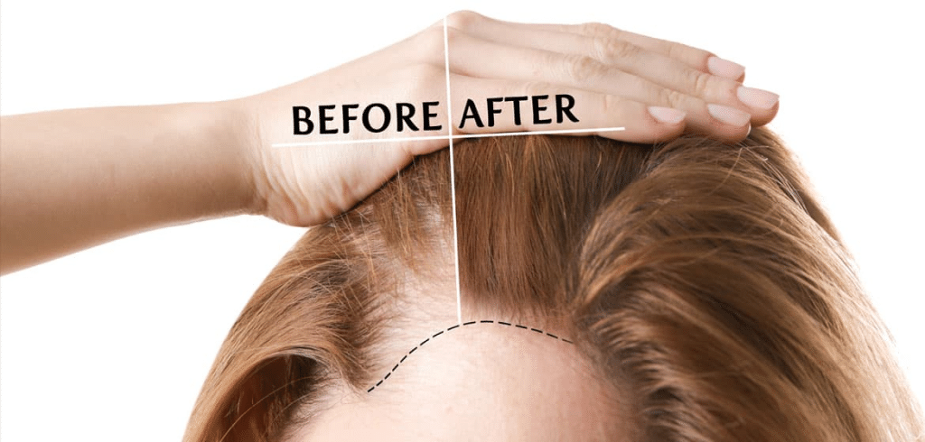 The Basics of Hair Transplants