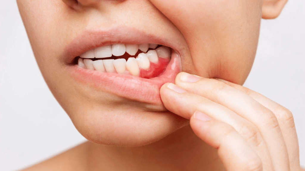 What Are Bleeding Gums?